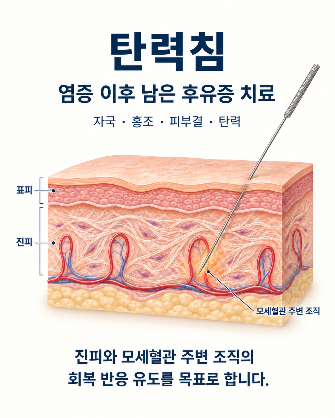 탄력침 치료 목표